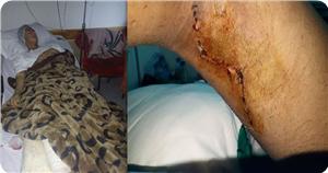 Katil Rejimin 17 Gün Önce Yaraladığı Gencin Yarası Bir Türlü İyileşmiyor