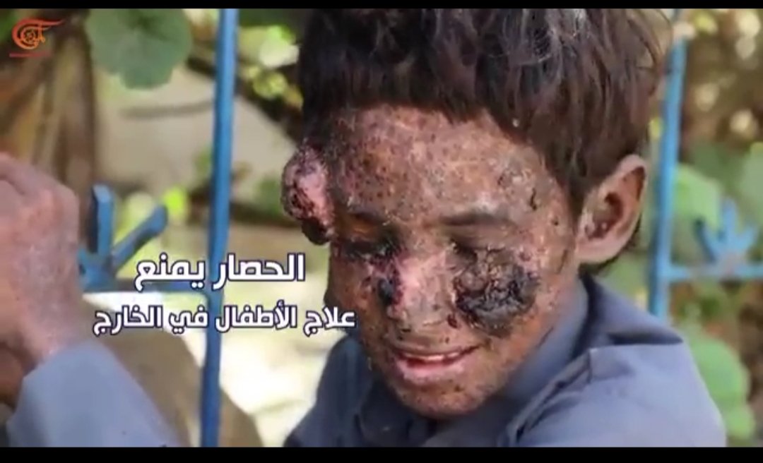 Suud Bombardımanı Sonucu Cilt Kanserine Yakalanan 4 Yemenli Çocuk İçin Yardım Seferberliğine Davet
